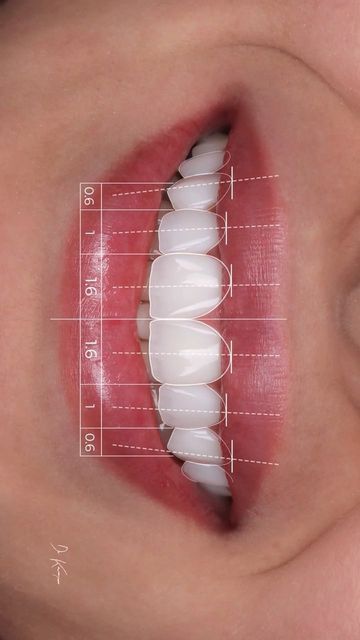 Faccetta in composito